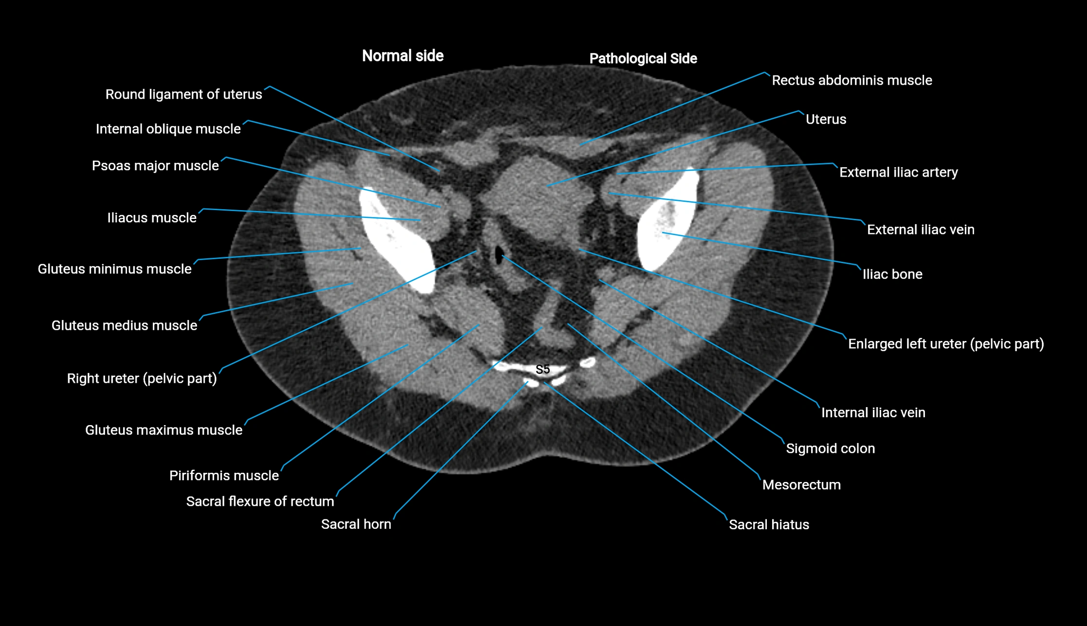 CT KUB axial cross sectional anatomy  radiology image -img-00201-00140.webp